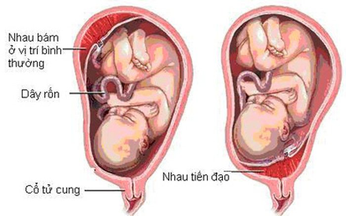7 nguyên nhân gây ra máu khi mang thai các mẹ bầu cần phải biết