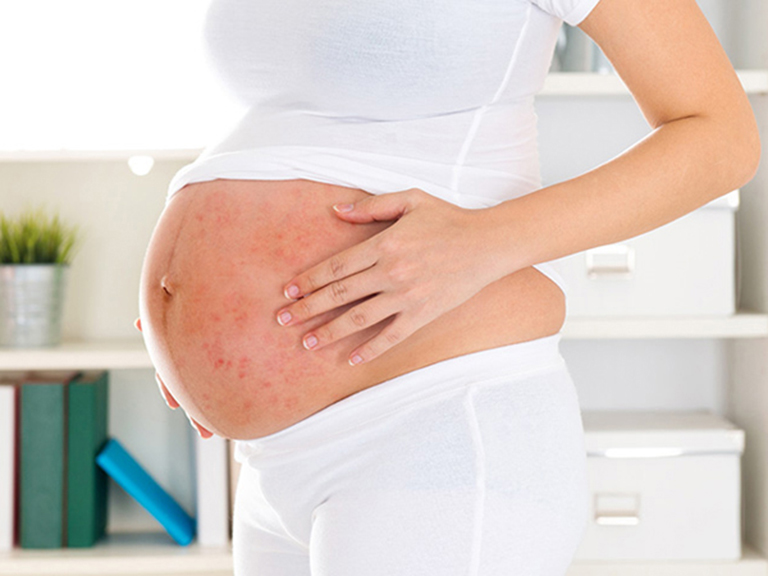 9 thay đổi ở làn da khi mang thai mà mẹ bầu nào cũng gặp phải