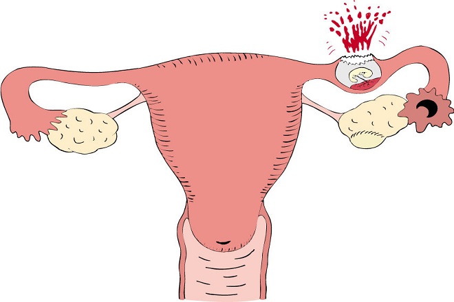 mang thai ngoài tử cung gây vỡ vòi trứng