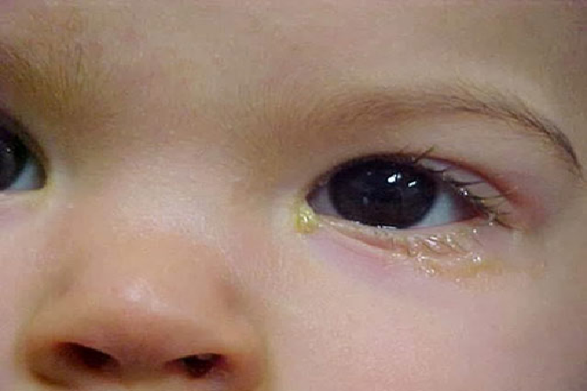 mắt thường bị ghèn là dấu hiệu trẻ bị tắc tuyến lệ