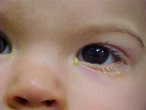 Nguyên nhân mắt trẻ sơ sinh bị ghèn và cách xử lý