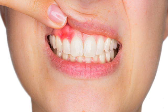 nướu răng viêm sưng là triệu chứng điển hình của bệnh viêm nha chu